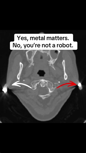 Understanding Metal's Impact in CT Scanning