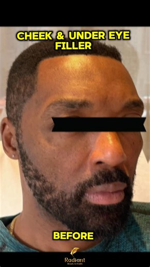 RadiantBeauty&Health on Instagram: "✨ Cheek + Under Eye Glow-Up ✨ Swipe to see this natural + refreshed transformation using Radiesse for the cheeks and Versa for the under eyes 💉✨ ⭐ Why Radiesse for Cheeks? • Adds structure + lift • Defines cheekbones • Boosts collagen for long-term rejuvenation ⭐ Why Versa for Under Eyes? • Smooths hollowness + shadows • Restores volume gently • Creates a brighter, well-rested look Subtle. Sculpted. Refreshed. ✨🔥 Multiple locations NY, CT, and Beverly Hills.