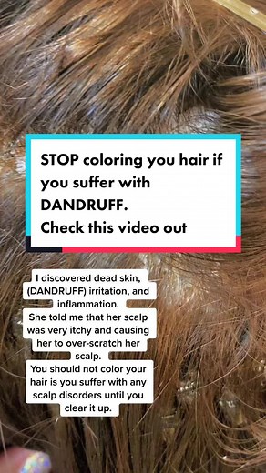 Understanding Dandruff and Scalp Health Solutions