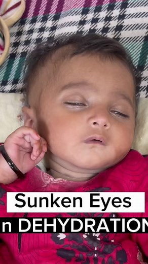 73K views · 796 reactions | Dehydration Sign #dehydration #infants #babies #diarrhea #sunkeneyes | Dr. Rizwan Gohar - Child Specialist - Pediatrician | Facebook