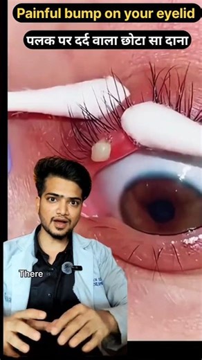 A painful bump on your eyelid, Stye explained | Never do this mistake . #facts # stye #eyes