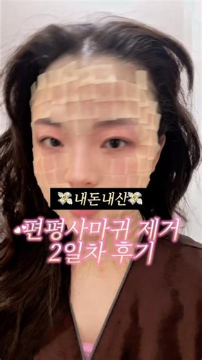 내돈내산 편평사마귀 제거 2일차 후기#편평사마귀 #피부과 #피부과시술 #피부관리 #요철관리