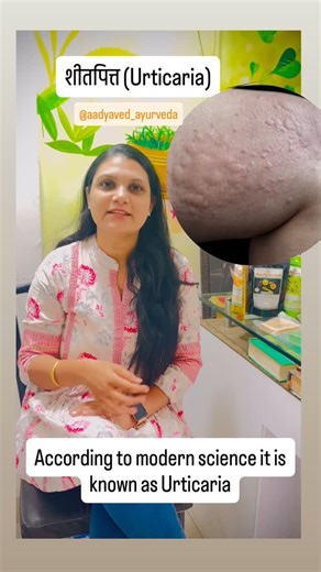 Dr. Ankita Tandel (Patil) | Shitapitta (Urticaria) treatment @aadyaved_ayurveda @baidyanathgroup @baidyanathglobal -Bruhat haridra khand powder #urticaria... | Instagram