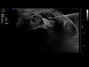 Median Nerve USG Hydrodissection