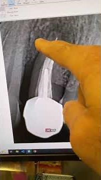 Criteria to consider for VRF. #dentists #dentalartistry #dentaltreatment #hygienist #apexdental