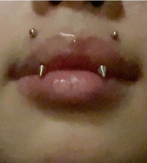 Exploring Angel Bites and Inverted Fangs