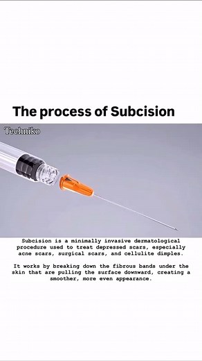 DrNinaKopaeva on Instagram: "Subcision is a minimally invasive dermatological procedure used to treat depressed scars, especially acne scars, surgical scars, and cellulite dimples. It works by breaking down the fibrous bands under the skin that are pulling the surface downward, creating a smoother, more even appearance. ⸻ How Subcision Works (Step-by-Step): 1. Topical Anesthetic Applied • Numbing cream or local anesthesia is used to minimize discomfort. 2. Insertion of a Special Needle (Cannula 