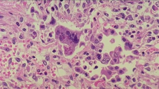 Measles exposure reported at Sharp Memorial Hospital ER