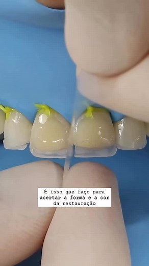 How to build Proximal wall using the Celloid Strip Credit @rafaelcsampaio #dentist #dentistry #kindness | Dental Art