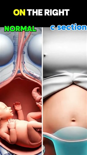 Normal Delivery vs C-Section: The Difference 🔬