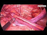 Laparoscopic Hernia Repair Large Sac TAPP Repair • Video • MEDtube.net