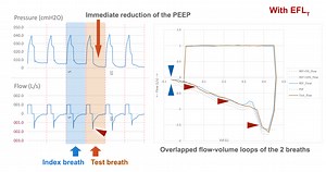 The Toronto Centre of Excellence in Mechanical Ventilation | Expiratory Flow Limitation (EFL)