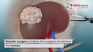 1.5K views · 162 reactions | Uncover the future of Urological...