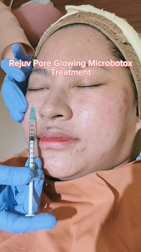 Treatment Microbotox at Dr. Widy Clinic in Ciputat