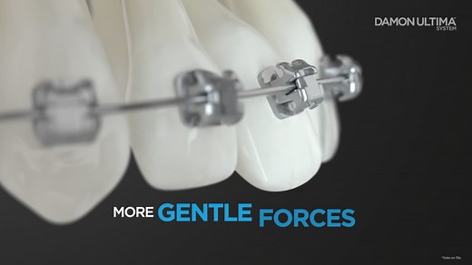 Designed for faster and more precise finishing to virtually eliminate play, with the Damon Ultima System you can*: - Achieve faster treatment times, fitting more patients into your schedule - Fully express your prescription with fewer wire bends, which may reduced chair time - Take advantage of fewer appointments, opening your appointment calendar To learn more about ways to grow your practice with the Damon Ultima System, visit: https://ormco.com/en-us/damon-ultima?utm_campaign=Damon&utm_source