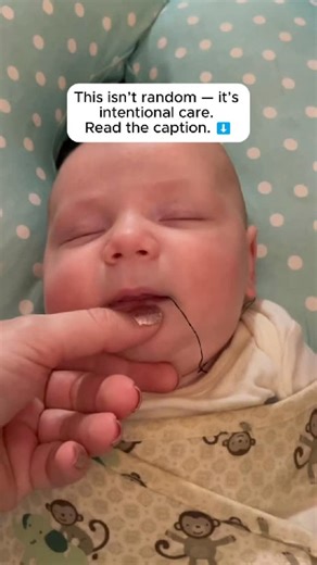 ACD | Pediatric Airway Dentists on Instagram: "What you’re seeing isn’t a random device. It is called a Neonatal ALF(Advanced Lightwire Functional)—a gentle, custom oral appliance designed specifically for infants to support palate development, tongue posture, neuromyofunction, and healthy airway growth during one of the most important windows of early life. This isn’t about moving teeth or treating disease. It’s about supporting normal development early, when the body is most adaptable. Researc