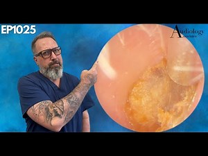 Satisfying Deep Keratin Plug & Wax Removal - EP1025