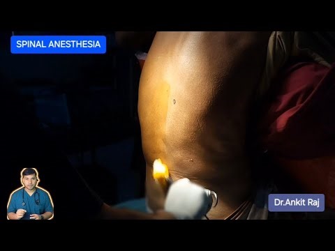 SPINAL ANESTHESIA (SA) step by step Procedure | Dr.Ankit | #anesthesia #doctor #mbbs #neetpg