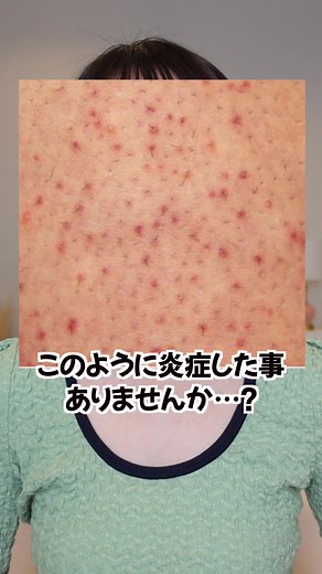 毛嚢炎の原因と対処法