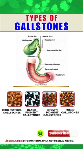 Different Types of Gallstones You Should Know