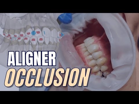 Occlusion for Aligners - Clinical Guidelines for GDPs - PDP250