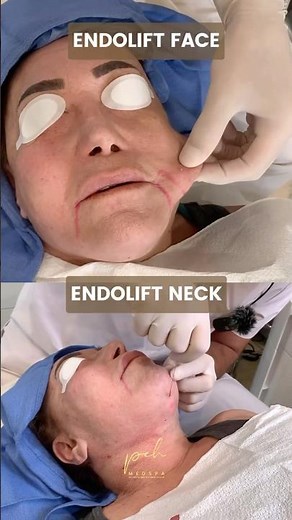 This Laser Treatment Gave Me a Facelift Without Surgery | Endolift Review