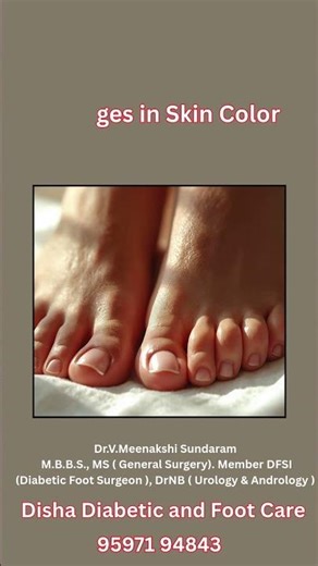 Common symptoms of Diabetic Feet | Diabetic Foot Treatment #shorts