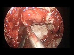Transsphenoideal Removal of Pituitary Tumor • Video • MEDtube.net