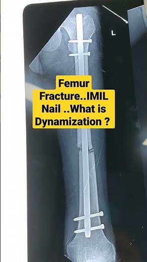 Femur Fracture..IMIL Nail ..What is Dynamization ?