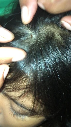 Humorous Lice Edit on TikTok