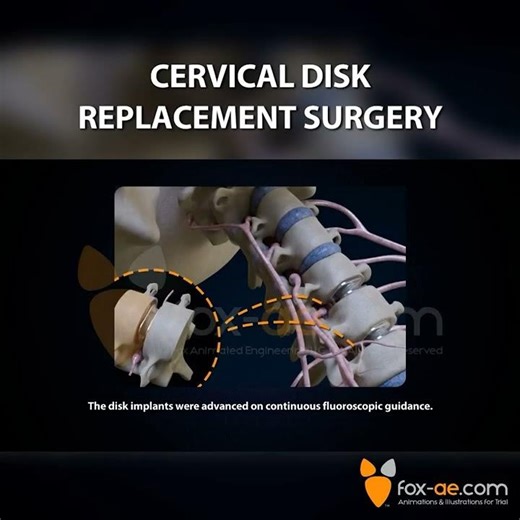 Cervical Disk Replacement Surgery
