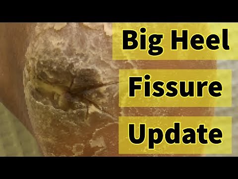 Big Heel Fissure Update: The Heel Has Finally Healed!