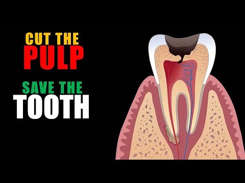 Pulpotomy in permanent teeth | Dr Benin