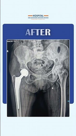 Expert Hip Fracture Surgery for Elderly | Best Hemiarthroplasty at OrthPlus Hospital, Surat