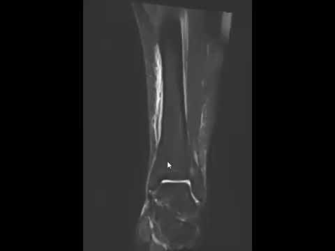 Tibial stress syndrome (shin splints)