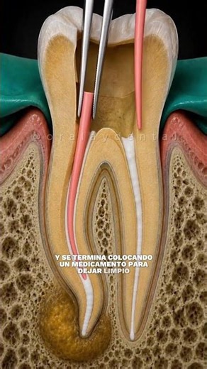 Treatments for a broken molar #rootcanal #dentalcaries