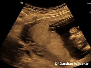 Chorionic Villus Sampling