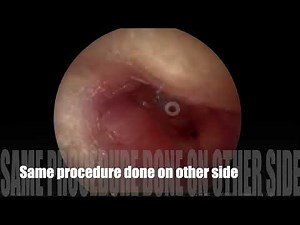 Endoscopic myringotomy with grommet insertion