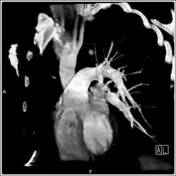 4D Imaging of the Aortic valve: Right Arch with Mirror Branching (3 of 3)