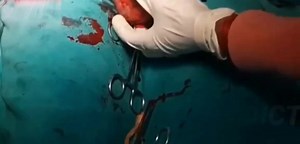 Orchiectomy Surgery
