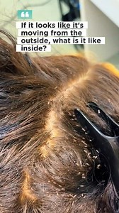 Head lice and their eggs were visible before treatment #HeadLice #LiceRemoval #LiceComb #LiceTreatment #LiceFree #LiceProblem #LiceCheck #LiceAwareness #HairCare #ViralLice | Ahmad
