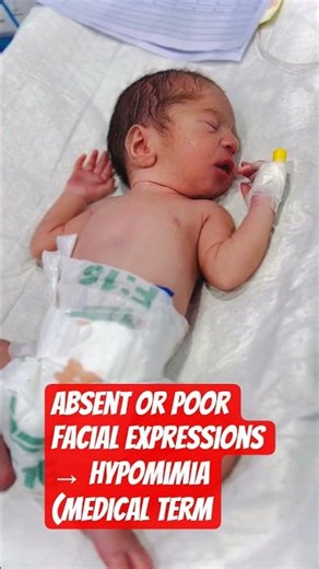 Absent or poor facial expressions → Hypomimia (medical term #newborn #cute #love