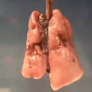 5K views · 130 reactions | Recrutamento alveolar - Diferentes níveis...