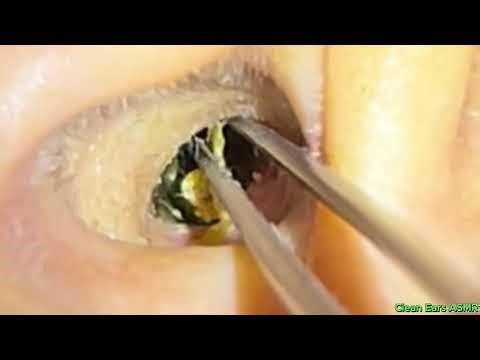 Real Ear Cleaning Sounds 🎧 No Talking, Just Pure ASMR