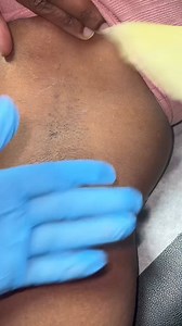 570K views · 13K reactions | Exfoliating is the main key to getting rid of discoloration! Of course, also having a consistent skin care/wax regimen is going to help!  FYI: everyones journey will be different when it comes to seeing results. #consistencyiskey Using Matcha by Wakse  #matcha #wax #foryou #skincareroutine #discoloration #exfoliate | Waxing Queen | Facebook