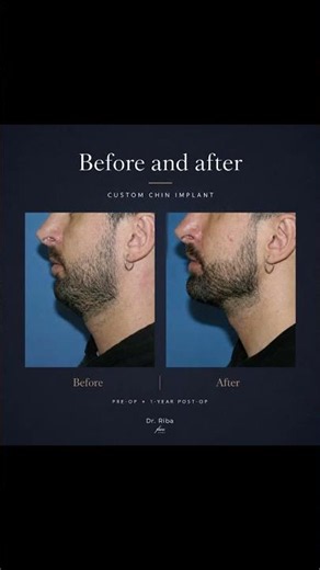 Custom 3D Chin Implant Before After | #FaceClinic #ChinImplant #facialimplants #chinaugmentation