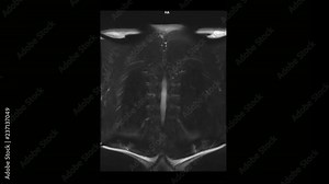 Computed medical tomography MRI scan of the thoracic spine of a man with osteochondrosis