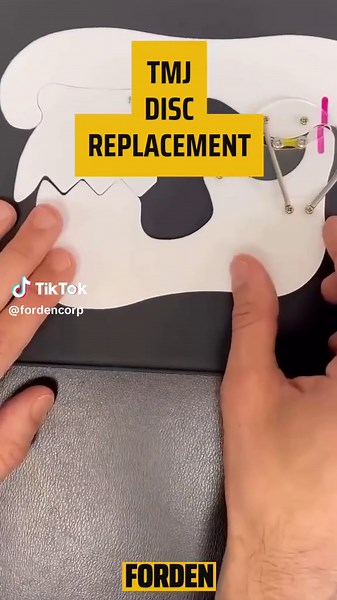 Do you experience jaw pain and limited opening or have you been diagnosed with TMD, and you’re trying to figure out the root cause? Or maybe you’ve been told that it is coming from your TMJ disc… and that there is a disc displacement without reduction meaning that it does not pop back into place. We can treat this by actually stretching the retro disco tissue, which can produce more movement and remodel into another disc believe it or not. Well if that’s the case this video will show your simple