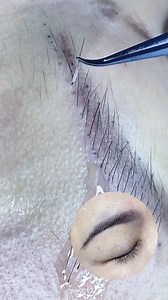 Eyebrow hair transplants are an excellent option for men and women who wish to restore their eyebrows permanently using their own natural hair. Depending on the severity of hair loss and your aesthetic goals, you can choose either a full or partial eyebrow transplant to restore thin spots. #hairtransplant #fue #browtransplant #browtransformation | Roni Bolton