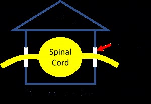 laminectomy fusion vs laminoplasty cervical spine